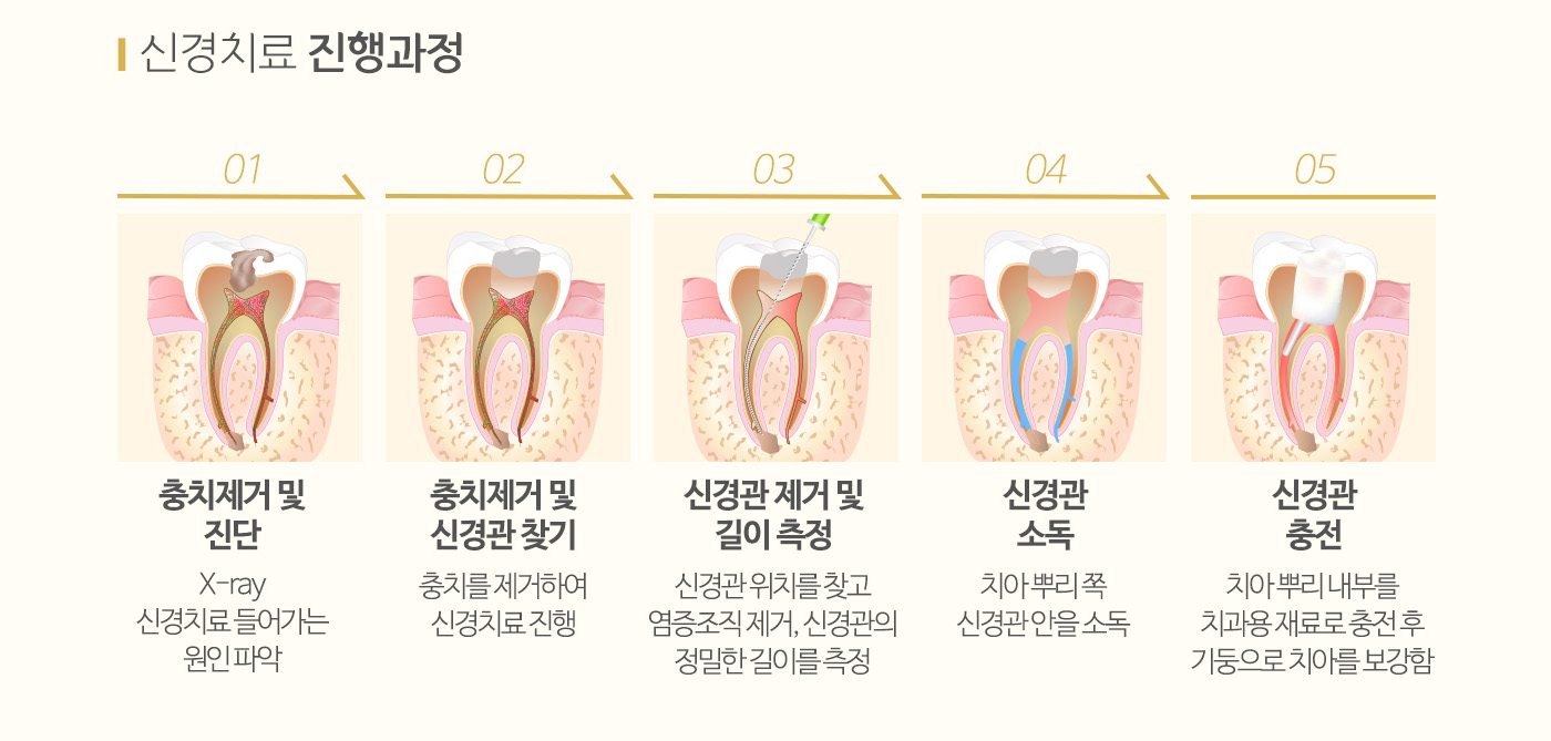 신경치료 진행 과정 안내 — 충치 제거 및 진단, 신경관 찾기, 신경관 제거 및 길이 측정, 신경관 소독, 신경관 충전